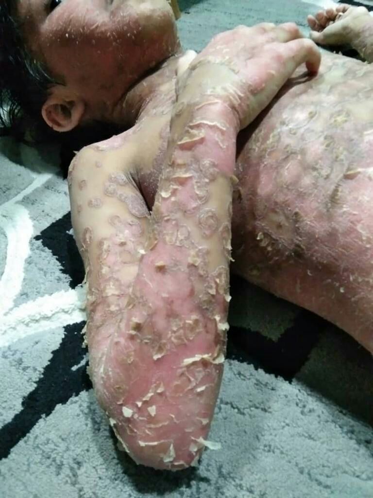 Rawatan kanak-kanak radang kulit mencecah RM25,000