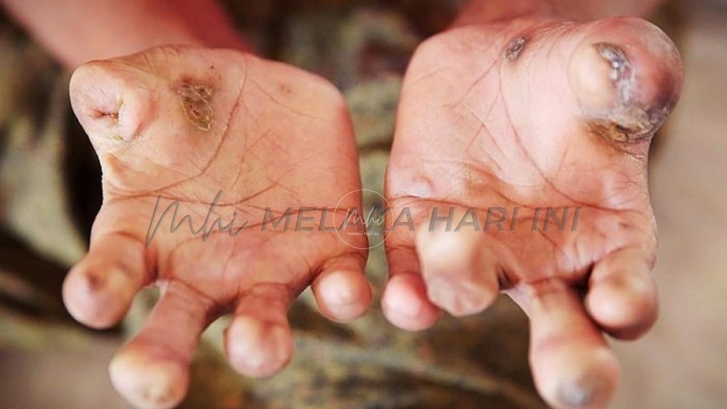 Masyarakat perlu cegah diskriminasi terhadap pesakit kusta -Khairy