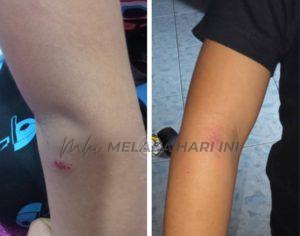 Cedera digigit anjing