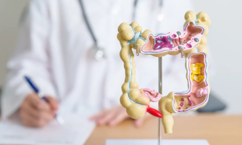 UJIAN SARINGAN KANSER KOLOREKTAL