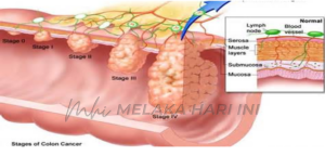 Shankar kolorektal 1