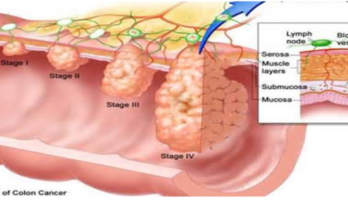 KANSER KOLOREKTAL: PEMBUNUH UTAMA KAUM LELAKI DI MALAYSIA