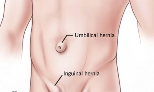 HERNIA INGUINAL: GEJALA DAN SIMPTOM