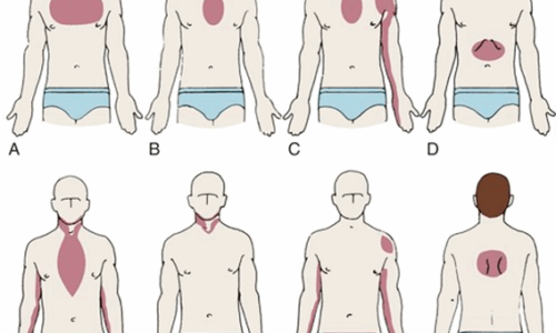 17.7% KEMATIAN DI MELAKA DISEBABKAN PENYAKIT JANTUNG KORONARI – ANDA BERISIKO?