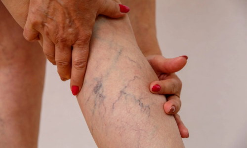 VENA VARIKOS: BUKAN SIMPUL BIASA