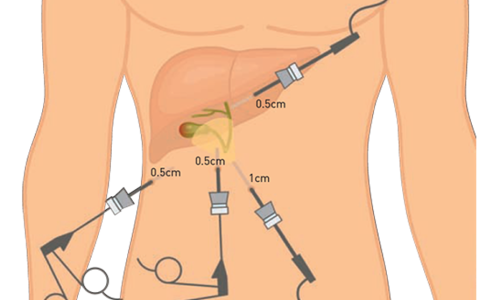 LAPAROSKOPI CHOLECYSTECTOMY: BILA PUNDI HEMPEDU PERLU DIKELUARKAN