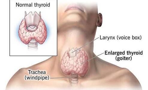 TIROID: APA PERLU ANDA TAHU?