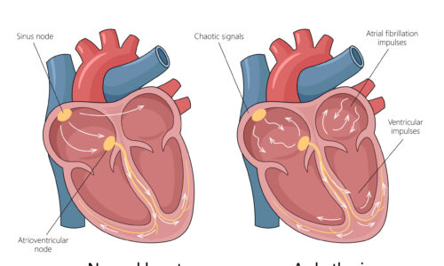 JANTUNG BERDEBAR TANPA SEBAB? INI MUNGKIN ARITMIA
